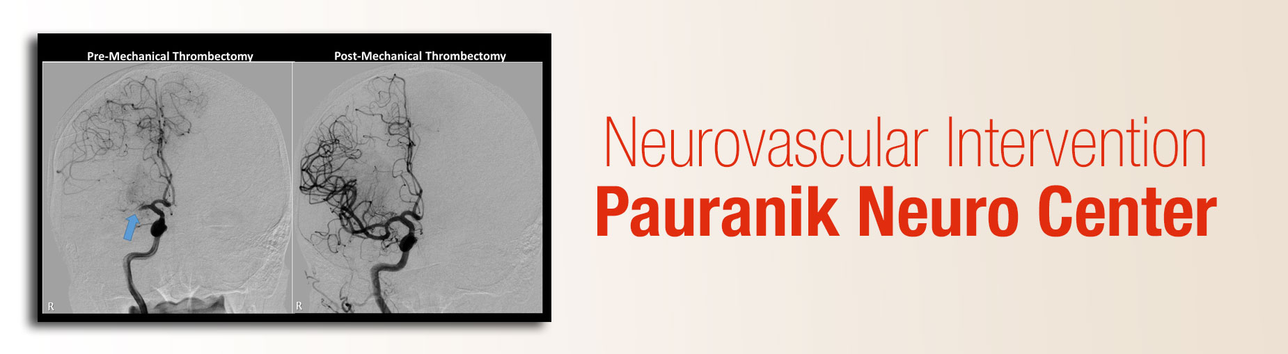 Stroke Specialist in Indore